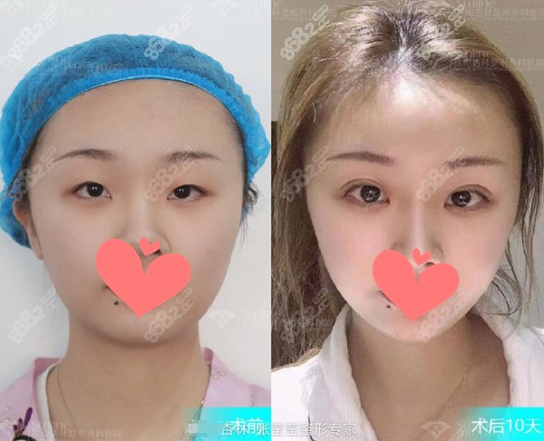 沈阳杏林眼综合前后对比照