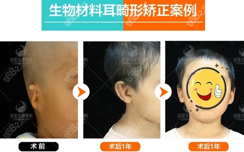 北京丽都安波小耳畸形矫正前后对比