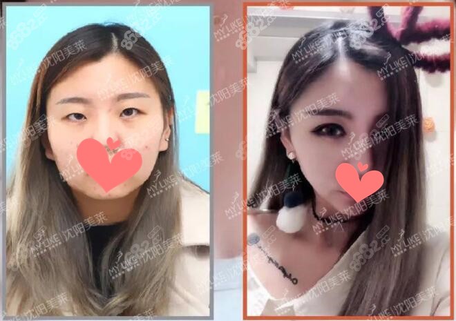 沈阳美莱眼综合前后对比照