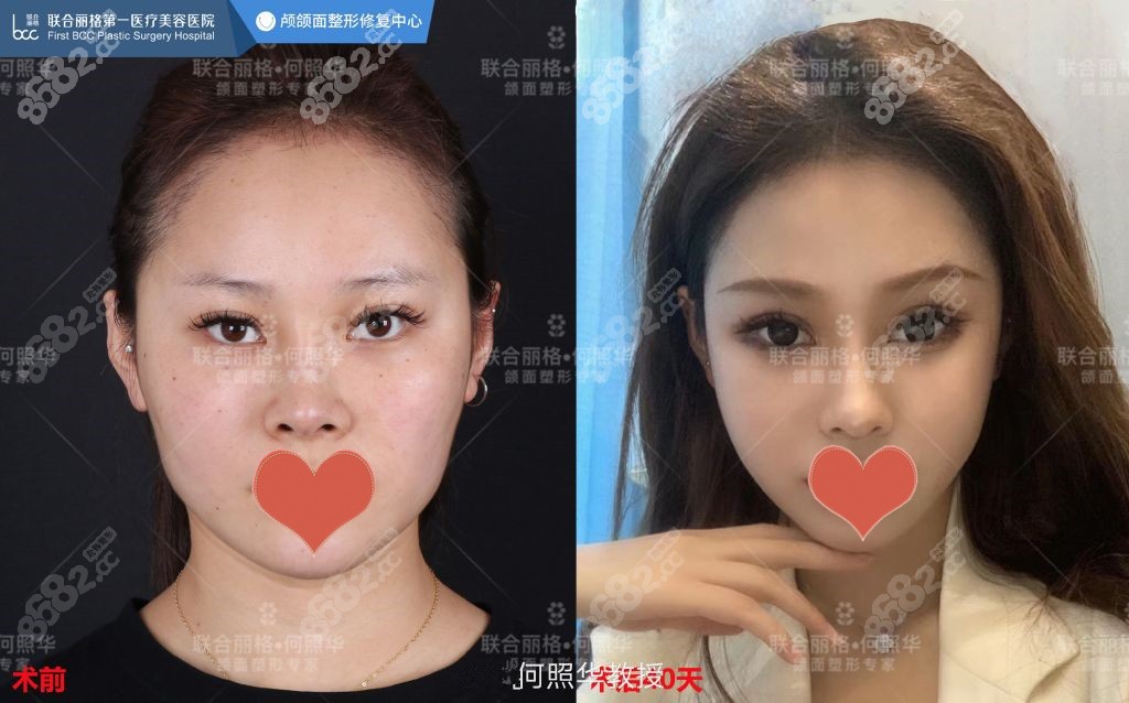 北京联合丽格磨骨对比照