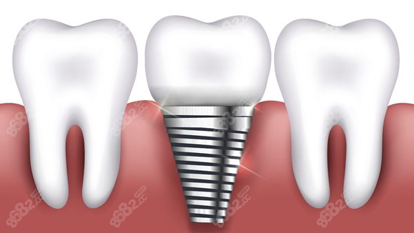 上海伊尔意口腔种植牙优势