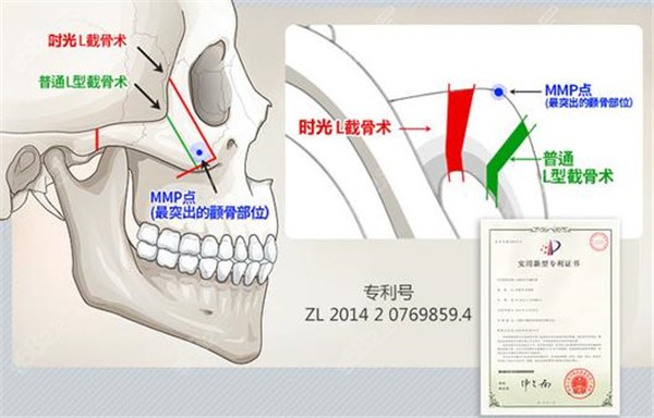 上海时光颧骨3D旋转截骨术