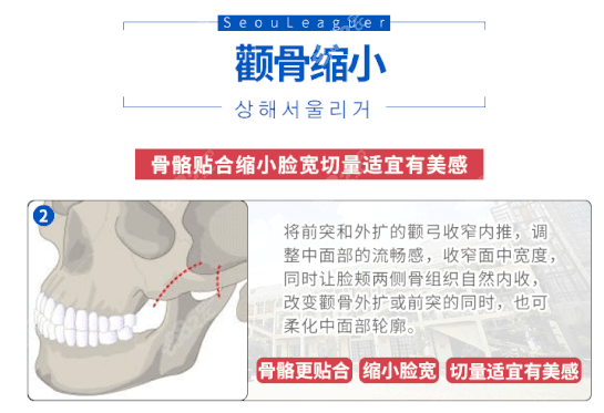 颧骨内推怎么样