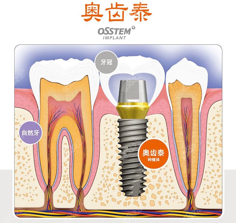 奥齿泰种植体的外观