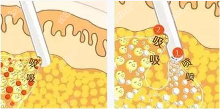 北京英煌医疗美容诊所自体脂肪隆胸