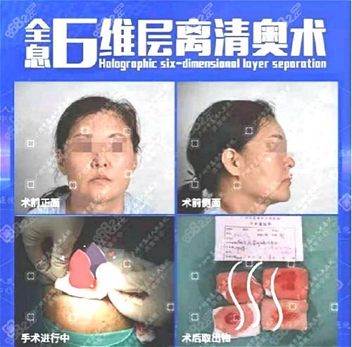 广州荔湾人民医院整形中心奥美定取出手术效果图