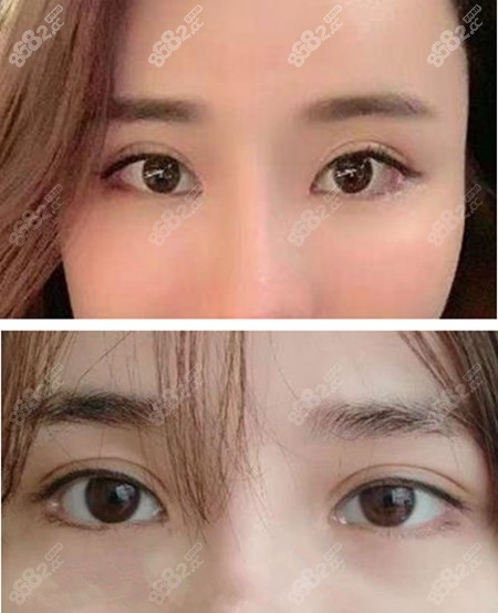 双眼皮修复手术前后对比