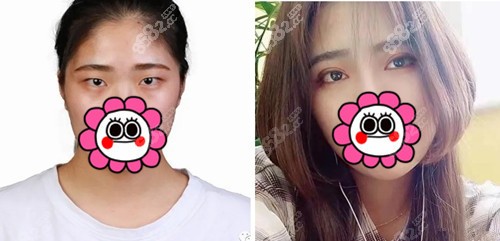 院长双眼皮手术前后对比图