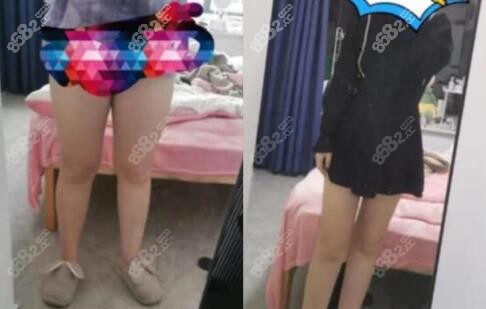 西安壹加壹王俊河做吸脂瘦大腿真人对比照