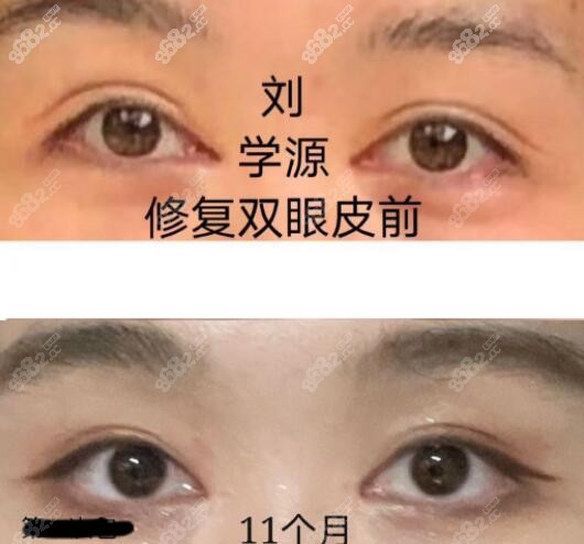 刘学源医生修复内眼角+双眼皮调整对比照