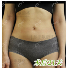 在北京丰联丽格做美式显微腰腹吸脂第21天