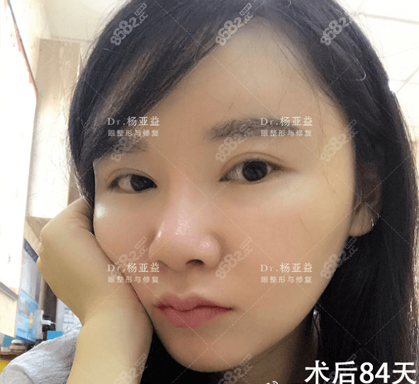 上海做眼修复好吗？我做的双眼皮过宽修复84天效果参考