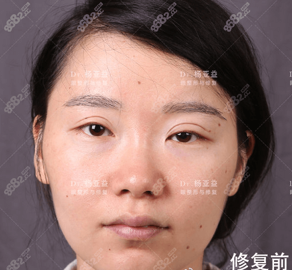 找上海华美做眼修复前