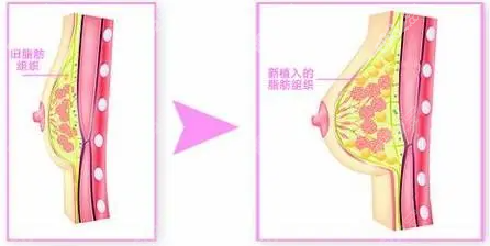 上海自体脂肪隆胸哪个医生好？