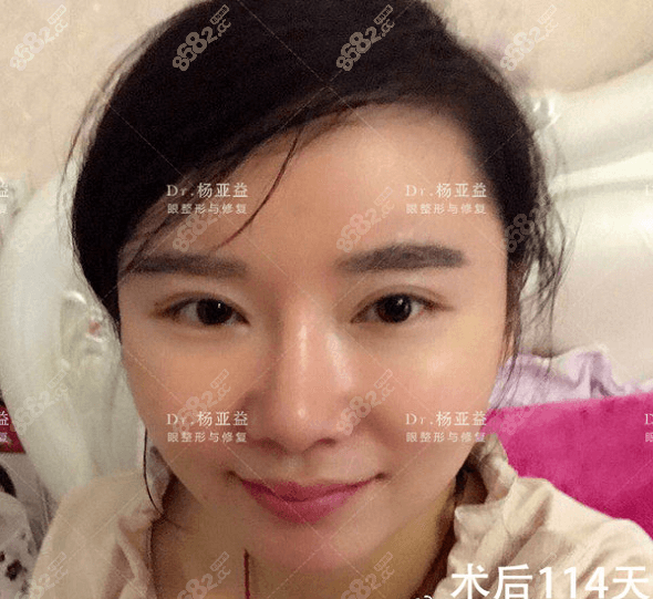 亲身体验上海做双眼皮修复技术挺好的