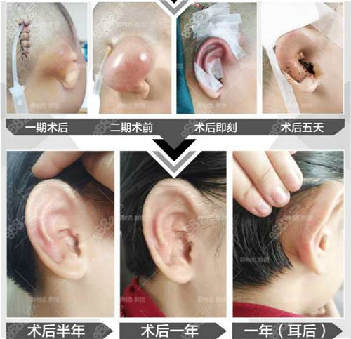 西安国 际郭树忠造四代耳再造术后效果图