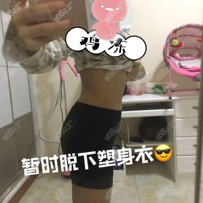 在南京美贝尔做完快乐吸脂瘦肚子术后1个月效果.jpg