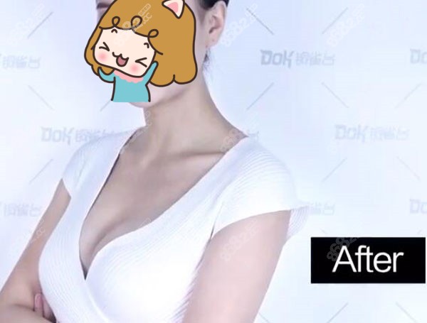 假体隆胸术后1周恢复效果