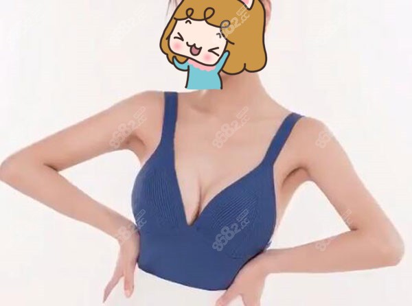 到昆明铜雀台做假体隆胸术后1月效果