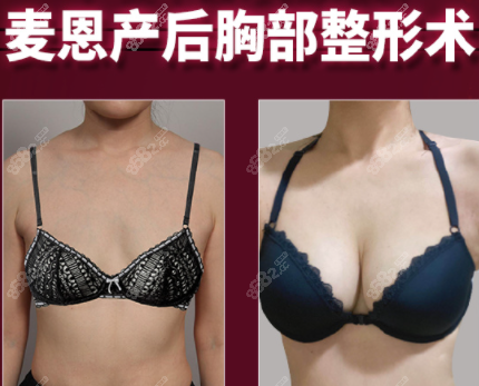 韩国麦恩产后隆胸效果图