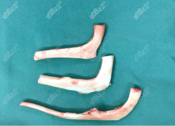 肋软骨支架做耳再造手术