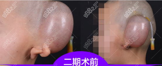 医生扩张皮肤的图片