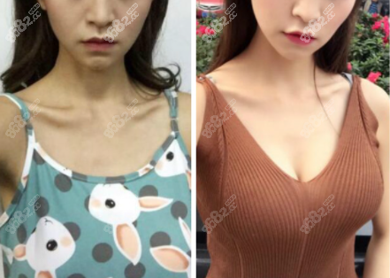 韩国棒棒魔滴隆胸效果图