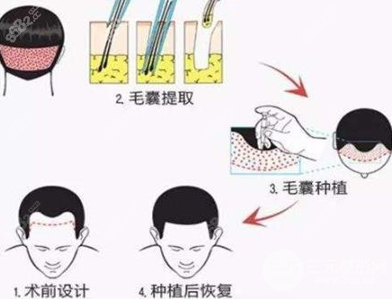 <!--<i data=20240705-sp></i>-->FUE无痕植发过程