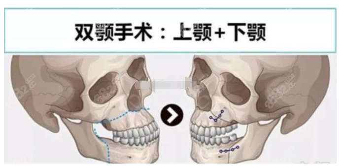 双鄂手术是上颚+下颚整形