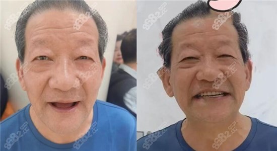 全口种植牙前后效果对比照片