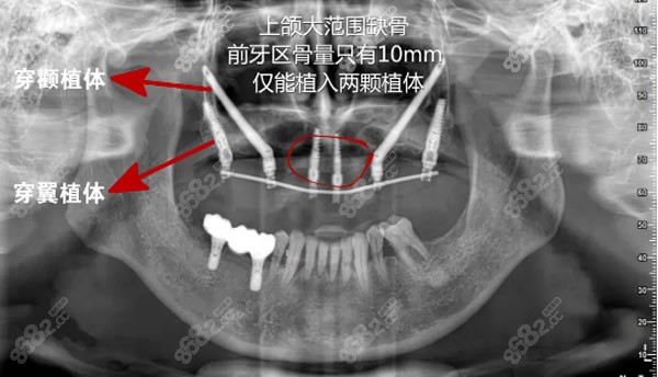 穿颧穿翼种植技术种植体植入的位置