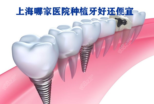 上海哪家医院种植牙便宜又好