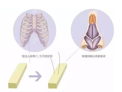 肋软骨隆鼻支架图解图片