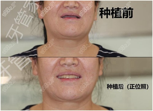 北京牙管家口腔种植牙前后<span style=