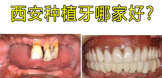西安种植牙好的医院排名榜，私立牙科医生技术靠谱又实惠