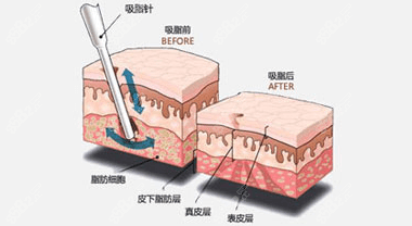 吸脂效果示意图