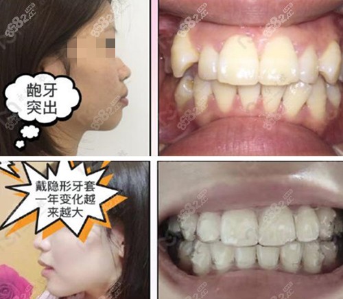 上海长宁区永华口腔牙齿矫正术前术后对比