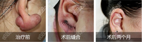在上海江城皮肤医院切除疤痕疙瘩效果图