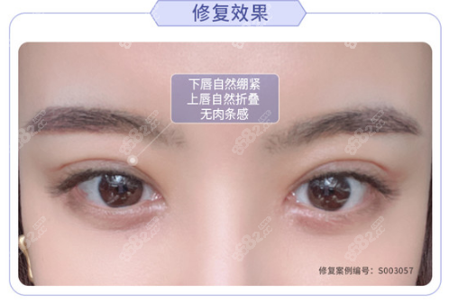 北京哪個醫(yī)生雙眼皮修復(fù)<span style=