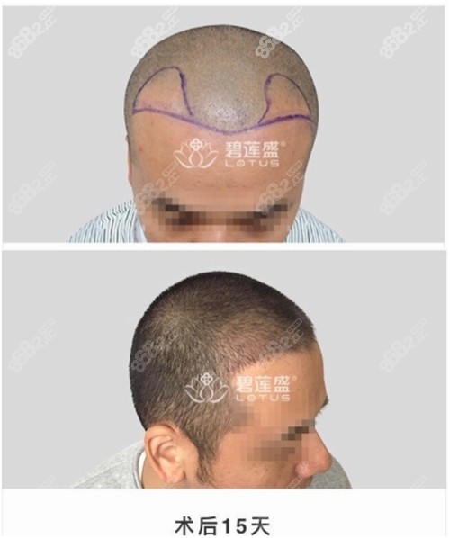 北京碧莲盛植发男士发际线种植效果