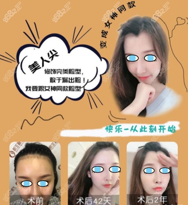 广州<!--<i data=20240705-sp></i>-->植发际线3000单位效果图片