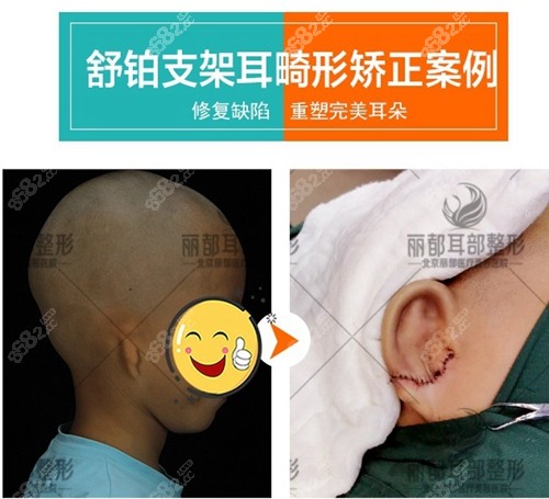 北京丽都安波耳畸形矫正前后对比图