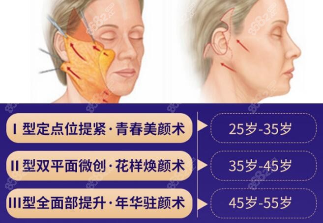 王驰医生做面部拉皮术的方式