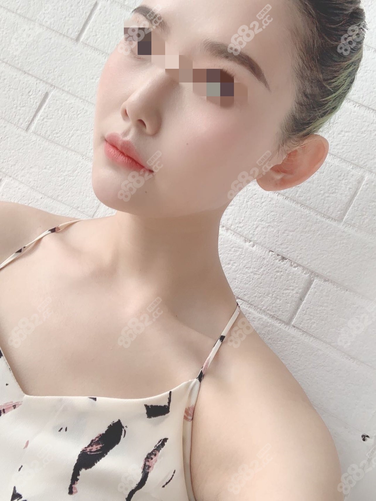 西安艺星整形埋线提升效果
