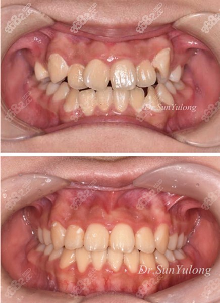 美奥口腔孙玉龙医生矫正病例