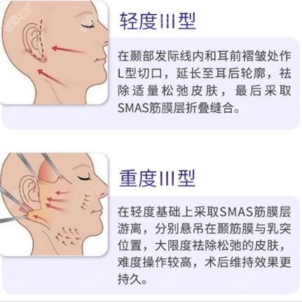 第三类拉皮手术的原理图