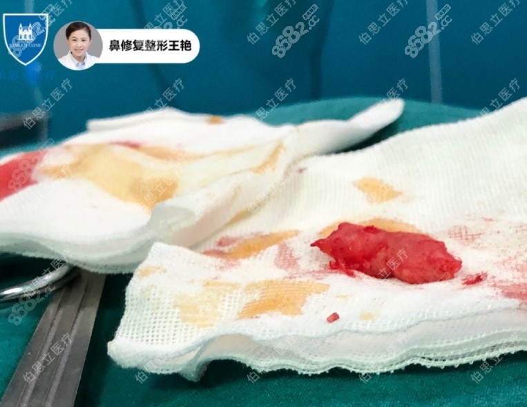 <!--<i data=20240705-sp></i>-->院长取出的骨粉