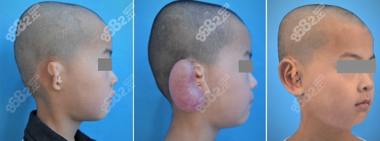 小耳畸形找北京八大处蒋海越和潘博哪个医生做耳再造好