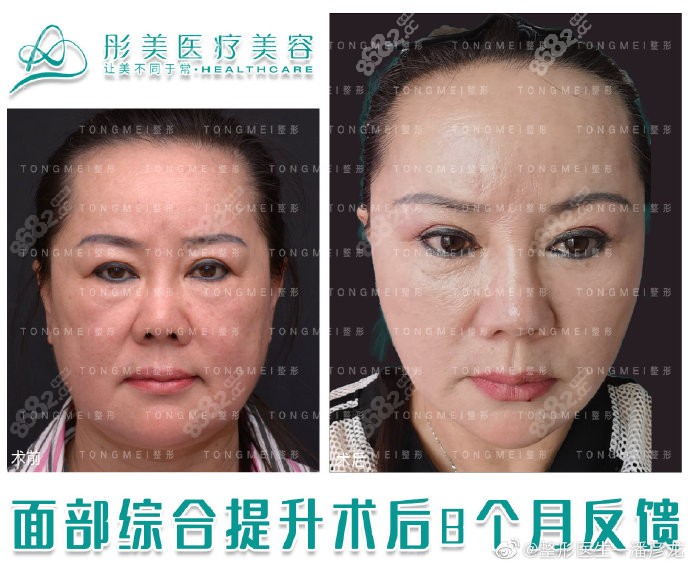 面部小切口提升术后8个多月，术前术后的变化