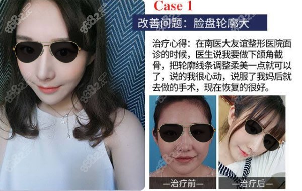 南京<!--<i data=20240705-sp></i>-->大友谊医院吴国平下颌角磨骨效果怎么样
